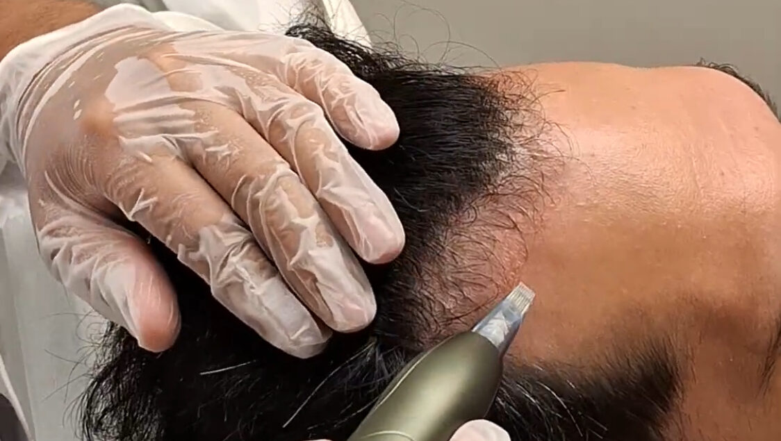 Microinfusão de Medicamentos na Pele: Um Boost de Tecnologia para Seus Fios