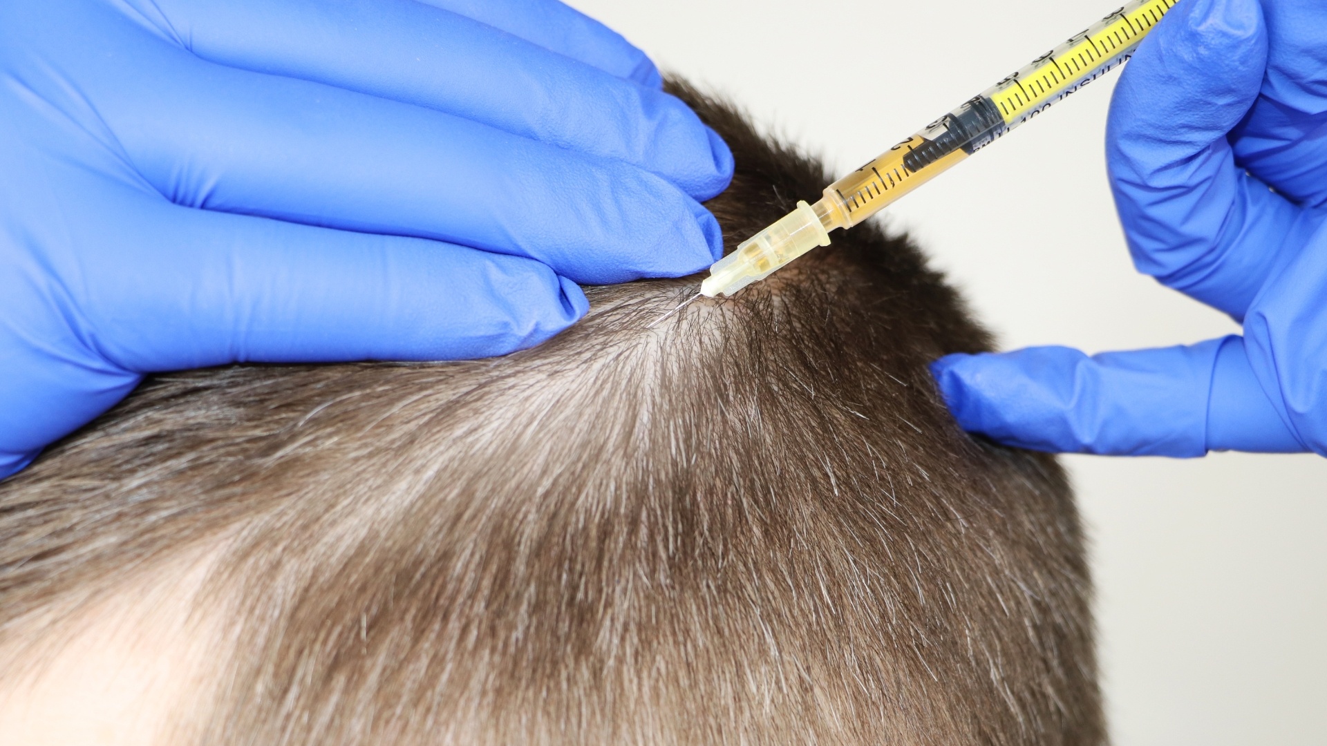 Procedimentos na Tricologia